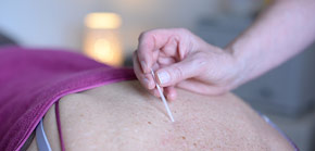 Chakra-puncture using Acupuncture needles lightly inserted